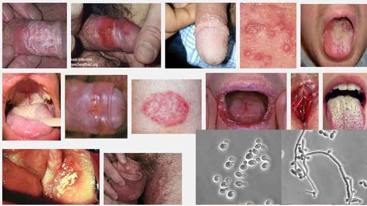 Bệnh nấm Candida da & niêm mạc: triệu chứng & điều trị
